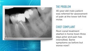 Advances in Endodontic Treatment Part 1Diagnosis and Treatment Planning [upl. by Faline]