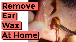 How To Remove Ear Wax at Home aka Impacted Cerumen [upl. by Adraynek]