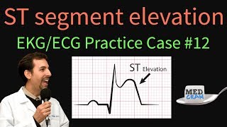 ST Elevation  EKG  ECG Interpretation Case 12 STEMI MI ACS [upl. by Remos]