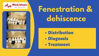 Inside Todds Head  superior semicircular canal dehiscence effects [upl. by Mordy]