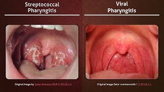 Streptococcal vs Viral Pharyngitis [upl. by Nnaeerb]