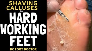 Hard Working Feet Trimming Thick Calluses [upl. by Onileva]