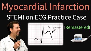 Myocardial Infarction  STEMI on ECG  Practice EKG [upl. by Terina]