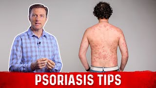 How to Get Rid of Psoriasis – Natural Remedies for Psoriasis by DrBerg [upl. by Faith562]