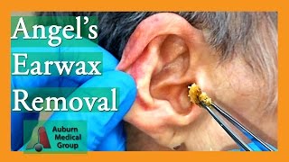 Angels Earwax Removal  Auburn Medical Group [upl. by Zerelda235]