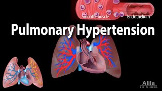 Pulmonary Hypertension Animation [upl. by Ecerehs]