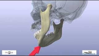 fractures of the mandibular condyle [upl. by Hannazus]