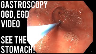 Gastroscopy What happens during the procedure [upl. by Held]