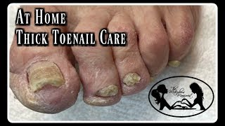 Pedicure At Home Elderly Toenails Cutting Thick Toenails and Nail Fungus [upl. by Ilojne592]