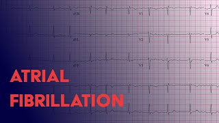 Atrial Fibrillation Afib  EKG ECG Interpretation [upl. by Nanyt]