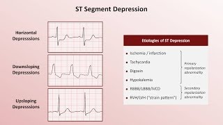 Intro to EKG Interpretation  QRST Changes [upl. by Wit]