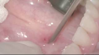 Submandibular Salivary Gland Sialendoscopy for Sialolithiasis [upl. by Ham]