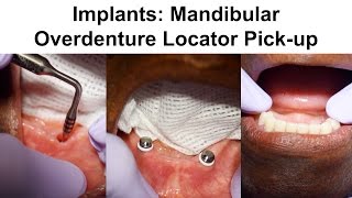 2 Implants Mandibular Overdenture Locator Pickup [upl. by Changaris]