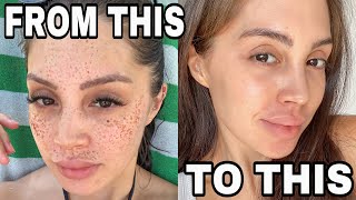 MY SKINCARE SECRETS  HOW I GOT RID OF MY FRECKLES [upl. by Accever898]