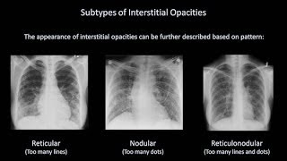 How to Interpret a Chest XRay Lesson 7  Diffuse Lung Processes [upl. by Ivgnout]