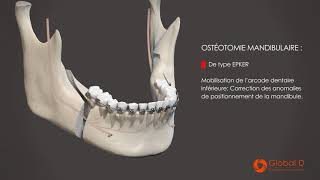 CMF  Film patient  Clivage Sagittal [upl. by Llenroc]