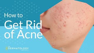 Acne Treatment  Explained by Dermatologist [upl. by Hullda]