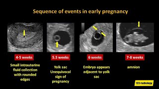 ULTRASOUND An Early View of Baby [upl. by Ennovyhc]