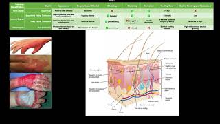 Classifying Burns EXPLAINED [upl. by Noedig]