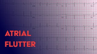 Atrial Flutter  EKG ECG Interpretation [upl. by Nilrah]