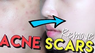 How To Get Rid of Acne Scars amp Hyperpigmentation • Get Brighter Skin [upl. by Chara22]